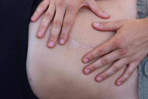 ScarWork: Hands-on Therapy for Integrating Scar Tissue into the Fascial Web photo